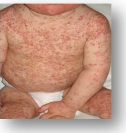 INMUNODEFICIENCIAS PRIMARIAS ¿cuando sospecharlas?