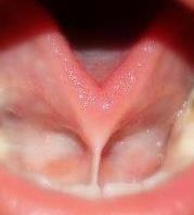 FRENILLO LINGUAL CORTO O ANQUILOGLOSIA.