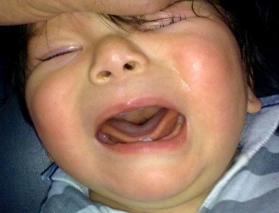 FACIES DE LLANTO ASIMETRICO