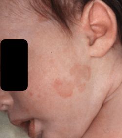 RECIEN NACIDO CON LESIONES REDONDAS EN PIEL.