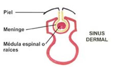 DISRAFISMO ESPINAL OCULTO