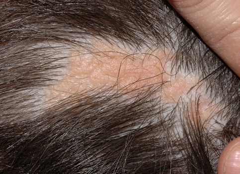 NEVUS SEBACEO DE JADASSOHN