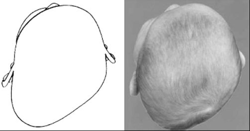 PLAGIOCEFALIA DEFORMACIONAL.