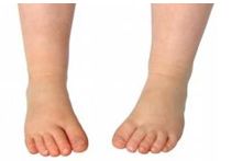 MARCHA CON PIES HACIA ADENTRO