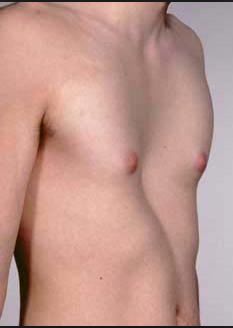 PECTUS EXCAVATUM