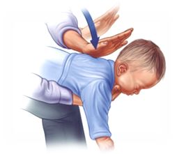 ASPIRACIÓN DE CUERPO EXTRAÑO EN NIÑOS.