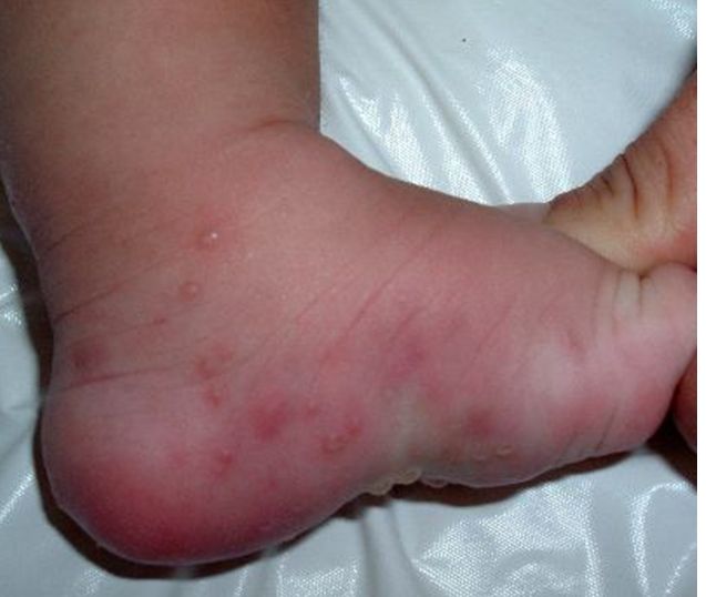 ACROPUSTULOSIS INFANTIL