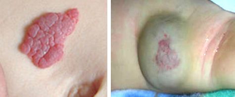 HEMANGIOMA  INFANTIL Y  HEMANGIOMA CONGENITO.