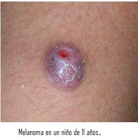MELANOMA EN NIÑOS.