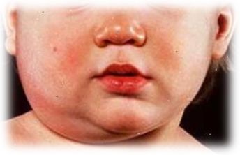 PAROTIDITIS RECURRENTE JUVENIL