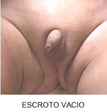 TESTICULO: CRIPTOQUIDICO CONGENITO - ADQUIRIDO – RETRACTIL.