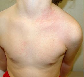 UN NIÑO CON UN EXANTEMA EN TRONCO