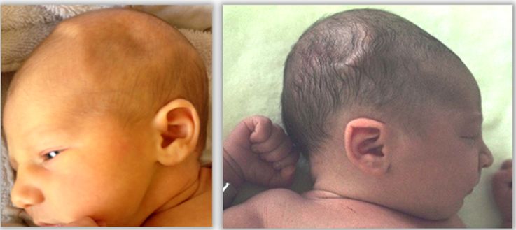 RECIEN NACIDO CON UN HUNDIMIENTO CRANEAL