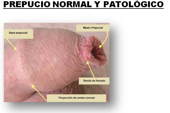 PREPUCIO NORMAL Y PATOLÓGICO