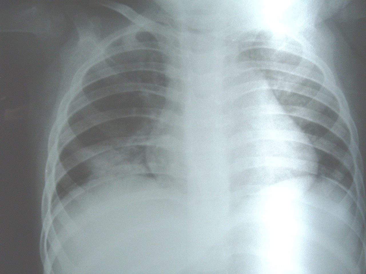 NEUMONÍA E INHIBIDORES DE LA ACIDEZ GASTRICA.