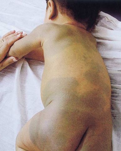 MANCHAS MONGÓLICAS - SIGNIFICADO